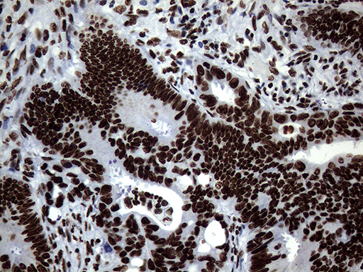 SH3BGRL Antibody - Immunohistochemical staining of paraffin-embedded Adenocarcinoma of Human colon tissue using anti-SH3BGRL mouse monoclonal antibody. (Heat-induced epitope retrieval by 1mM EDTA in 10mM Tris buffer. (pH8.5) at 120°C for 3 min. (1:150)