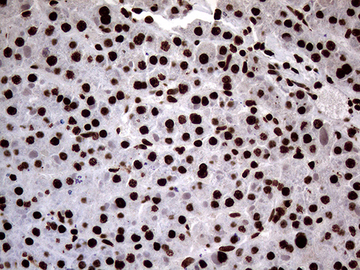 SH3BGRL Antibody - Immunohistochemical staining of paraffin-embedded Carcinoma of Human liver tissue using anti-SH3BGRL mouse monoclonal antibody. (Heat-induced epitope retrieval by 1mM EDTA in 10mM Tris buffer. (pH8.5) at 120°C for 3 min. (1:150)