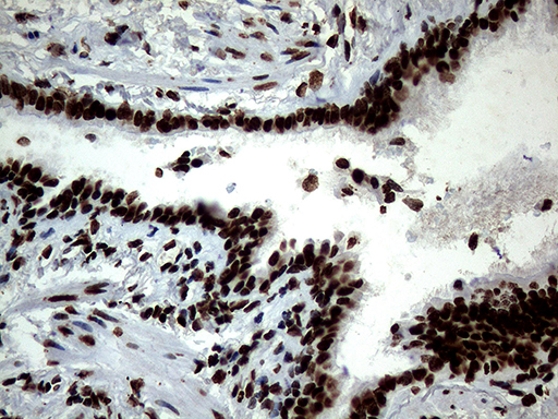SH3BGRL Antibody - Immunohistochemical staining of paraffin-embedded Human lung tissue within the normal limits using anti-SH3BGRL mouse monoclonal antibody. (Heat-induced epitope retrieval by 1mM EDTA in 10mM Tris buffer. (pH8.5) at 120°C for 3 min. (1:150)