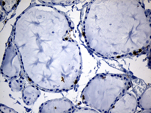 SH3BP1 Antibody - Immunohistochemical staining of paraffin-embedded Human thyroid tissue within the normal limits using anti-SH3BP1 mouse monoclonal antibody. (Heat-induced epitope retrieval by 1mM EDTA in 10mM Tris buffer. (pH8.5) at 120°C for 3 min. (1:500)
