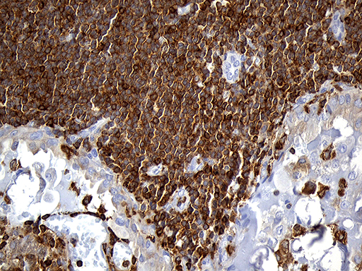 SH3BP1 Antibody - Immunohistochemical staining of paraffin-embedded Carcinoma of Human thyroid tissue using anti-SH3BP1 mouse monoclonal antibody. (Heat-induced epitope retrieval by 1mM EDTA in 10mM Tris buffer. (pH8.5) at 120°C for 3 min. (1:500)