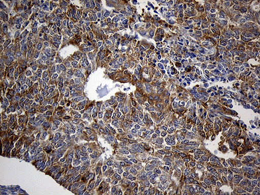 SH3BP1 Antibody - Immunohistochemical staining of paraffin-embedded Adenocarcinoma of Human endometrium tissue using anti-SH3BP1 mouse monoclonal antibody. (Heat-induced epitope retrieval by 1mM EDTA in 10mM Tris buffer. (pH8.5) at 120°C for 3 min. (1:500)