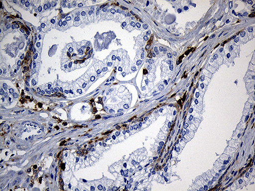 SH3BP1 Antibody - Immunohistochemical staining of paraffin-embedded Carcinoma of Human prostate tissue using anti-SH3BP1 mouse monoclonal antibody. (Heat-induced epitope retrieval by 1mM EDTA in 10mM Tris buffer. (pH8.5) at 120°C for 3 min. (1:500)