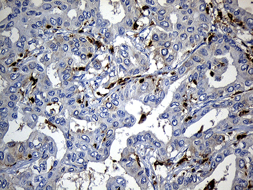 SH3BP1 Antibody - Immunohistochemical staining of paraffin-embedded Carcinoma of Human liver tissue using anti-SH3BP1 mouse monoclonal antibody. (Heat-induced epitope retrieval by 1mM EDTA in 10mM Tris buffer. (pH8.5) at 120°C for 3 min. (1:500)