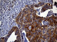 SH3BP1 Antibody - Immunohistochemical staining of paraffin-embedded Adenocarcinoma of Human colon tissue using anti-SH3BP1 mouse monoclonal antibody. (Heat-induced epitope retrieval by 1mM EDTA in 10mM Tris buffer. (pH8.5) at 120°C for 3 min. (1:2000)