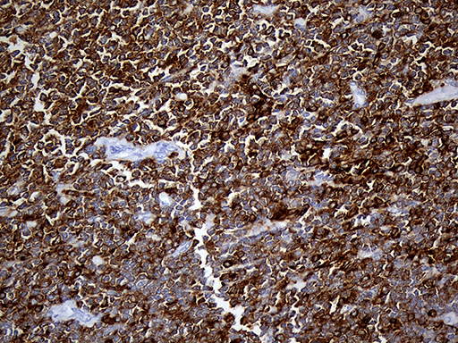 SH3BP1 Antibody - Immunohistochemical staining of paraffin-embedded Human lymphoma tissue using anti-SH3BP1 mouse monoclonal antibody. (Heat-induced epitope retrieval by 1mM EDTA in 10mM Tris buffer. (pH8.5) at 120°C for 3 min. (1:500)