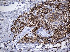 SH3BP1 Antibody - Immunohistochemical staining of paraffin-embedded Carcinoma of Human lung tissue using anti-SH3BP1 mouse monoclonal antibody. (Heat-induced epitope retrieval by 1mM EDTA in 10mM Tris buffer. (pH8.5) at 120°C for 3 min. (1:500)