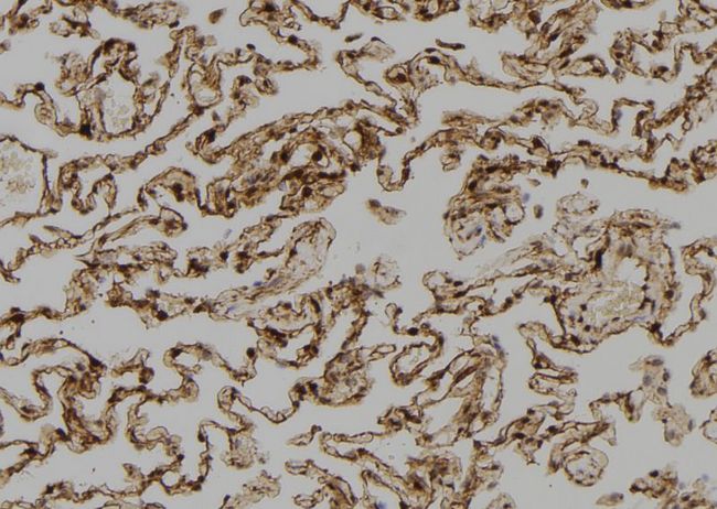 SH3BP2 Antibody - 1:100 staining human lung tissue by IHC-P. The sample was formaldehyde fixed and a heat mediated antigen retrieval step in citrate buffer was performed. The sample was then blocked and incubated with the antibody for 1.5 hours at 22°C. An HRP conjugated goat anti-rabbit antibody was used as the secondary.