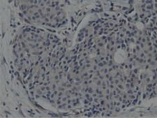 SH3GL1 / EEN Antibody - IHC of paraffin-embedded Adenocarcinoma of Human breast tissue using anti-SH3GL1 mouse monoclonal antibody.