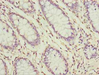 SH3GL1 / EEN Antibody - Immunohistochemistry of paraffin-embedded human colon cancer at dilution 1:100