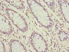 SH3GL1 / EEN Antibody - Immunohistochemistry of paraffin-embedded human colon cancer at dilution 1:100