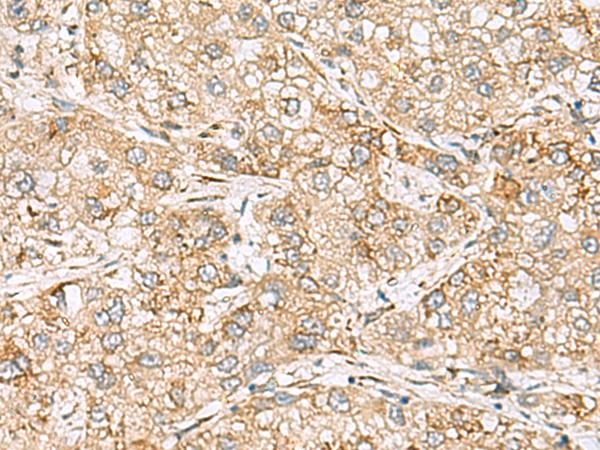 SH3GL2 Antibody - Immunohistochemistry of paraffin-embedded Human liver cancer tissue  using SH3GL2 Polyclonal Antibody at dilution of 1:80(×200)