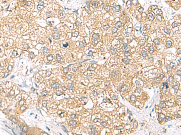 SH3GL2 Antibody - Immunohistochemistry of paraffin-embedded Human liver cancer tissue  using SH3GL2 Polyclonal Antibody at dilution of 1:45(×200)