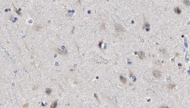 SH3GL3 Antibody - 1:100 staining human brain carcinoma tissue by IHC-P. The sample was formaldehyde fixed and a heat mediated antigen retrieval step in citrate buffer was performed. The sample was then blocked and incubated with the antibody for 1.5 hours at 22°C. An HRP conjugated goat anti-rabbit antibody was used as the secondary.