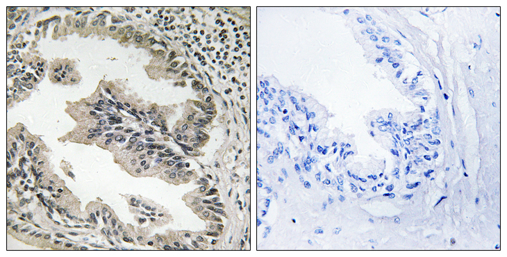 SH3GLB2 / Endophilin-B2 Antibody - Immunohistochemistry analysis of paraffin-embedded human prostate carcinoma tissue, using SH3GLB2 Antibody. The picture on the right is blocked with the synthesized peptide.