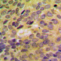 SH3GLB2 / Endophilin-B2 Antibody - Immunohistochemical analysis of SH3GLB2 staining in human breast cancer formalin fixed paraffin embedded tissue section. The section was pre-treated using heat mediated antigen retrieval with sodium citrate buffer (pH 6.0). The section was then incubated with the antibody at room temperature and detected using an HRP conjugated compact polymer system. DAB was used as the chromogen. The section was then counterstained with hematoxylin and mounted with DPX.