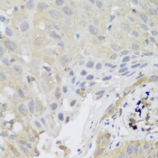 SH3GLB2 / Endophilin-B2 Antibody - Immunohistochemistry of paraffin-embedded human lung cancer tissue.