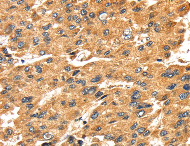 SH3KBP1 / CIN85 Antibody - Immunohistochemistry of paraffin-embedded Human breast cancer using SH3KBP1 Polyclonal Antibody at dilution of 1:45.