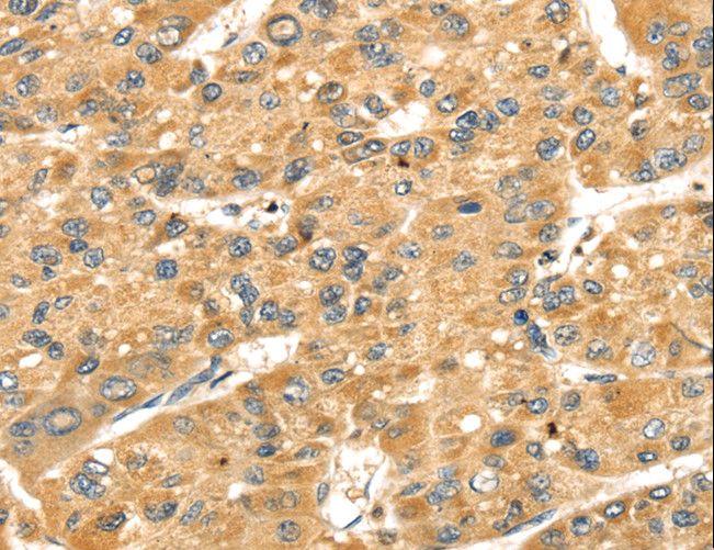 SH3KBP1 / CIN85 Antibody - Immunohistochemistry of paraffin-embedded Human liver cancer using SH3KBP1 Polyclonal Antibody at dilution of 1:40.