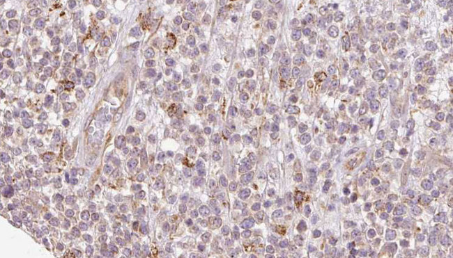 SH3KBP1 / CIN85 Antibody - 1:100 staining human lymph carcinoma tissue by IHC-P. The sample was formaldehyde fixed and a heat mediated antigen retrieval step in citrate buffer was performed. The sample was then blocked and incubated with the antibody for 1.5 hours at 22°C. An HRP conjugated goat anti-rabbit antibody was used as the secondary.