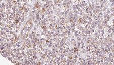 SH3KBP1 / CIN85 Antibody - 1:100 staining human lymph carcinoma tissue by IHC-P. The sample was formaldehyde fixed and a heat mediated antigen retrieval step in citrate buffer was performed. The sample was then blocked and incubated with the antibody for 1.5 hours at 22°C. An HRP conjugated goat anti-rabbit antibody was used as the secondary.