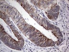 SH3P7 / HIP-55 Antibody - Immunohistochemical staining of paraffin-embedded Adenocarcinoma of Human colon tissue using anti-DBNL mouse monoclonal antibody. (Heat-induced epitope retrieval by 1 mM EDTA in 10mM Tris, pH8.5, 120C for 3min,