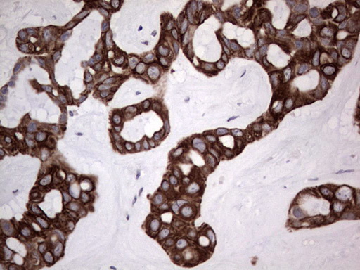 SH3P7 / HIP-55 Antibody - Immunohistochemical staining of paraffin-embedded Carcinoma of Human liver tissue using anti-DBNL mouse monoclonal antibody. (Heat-induced epitope retrieval by 1 mM EDTA in 10mM Tris, pH8.5, 120C for 3min,