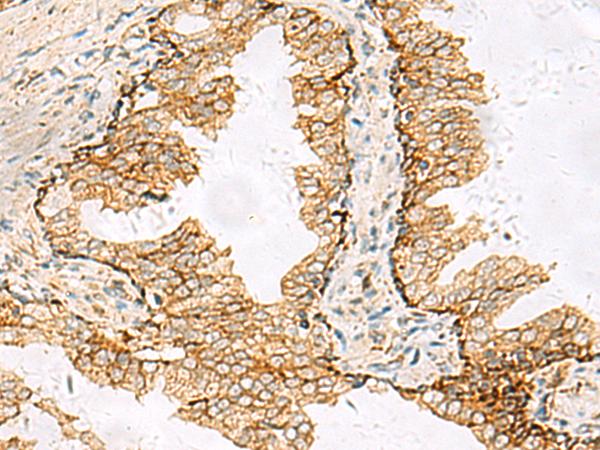 SH3YL1 Antibody - Immunohistochemistry of paraffin-embedded Human prost at e cancer tissue  using SH3YL1 Polyclonal Antibody at dilution of 1:55(×200)