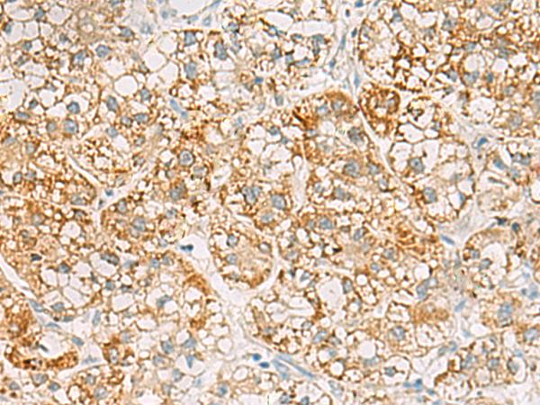 SH3YL1 Antibody - Immunohistochemistry of paraffin-embedded Human liver cancer tissue  using SH3YL1 Polyclonal Antibody at dilution of 1:55(×200)