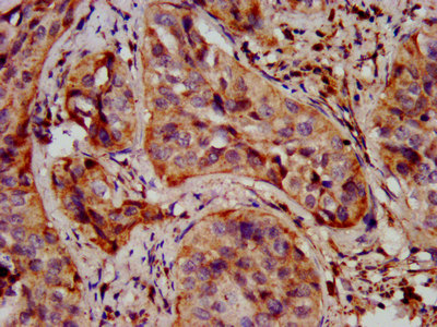 SHANK2 / SHANK Antibody - Immunohistochemistry image at a dilution of 1:400 and staining in paraffin-embedded human cervical cancer performed on a Leica BondTM system. After dewaxing and hydration, antigen retrieval was mediated by high pressure in a citrate buffer (pH 6.0) . Section was blocked with 10% normal goat serum 30min at RT. Then primary antibody (1% BSA) was incubated at 4 °C overnight. The primary is detected by a biotinylated secondary antibody and visualized using an HRP conjugated SP system.