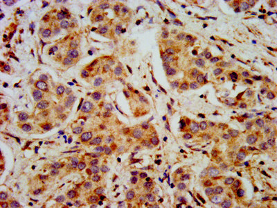 SHANK2 / SHANK Antibody - Immunohistochemistry image at a dilution of 1:400 and staining in paraffin-embedded human liver cancer performed on a Leica BondTM system. After dewaxing and hydration, antigen retrieval was mediated by high pressure in a citrate buffer (pH 6.0) . Section was blocked with 10% normal goat serum 30min at RT. Then primary antibody (1% BSA) was incubated at 4 °C overnight. The primary is detected by a biotinylated secondary antibody and visualized using an HRP conjugated SP system.