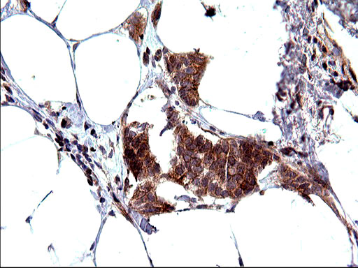 SHBG Antibody - IHC of paraffin-embedded Adenocarcinoma of Human breast tissue using anti-SHBG mouse monoclonal antibody. (Heat-induced epitope retrieval by 10mM citric buffer, pH6.0, 120°C for 3min).