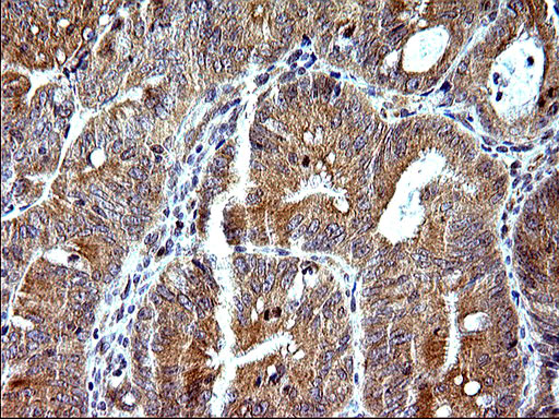 SHBG Antibody - IHC of paraffin-embedded Carcinoma of Human pancreas tissue using anti-SHBG mouse monoclonal antibody. (Heat-induced epitope retrieval by 10mM citric buffer, pH6.0, 120°C for 3min).