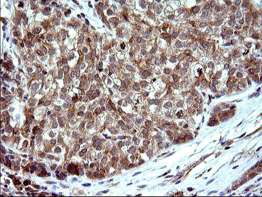 SHBG Antibody - IHC of paraffin-embedded Carcinoma of Human liver tissue using anti-SHBG mouse monoclonal antibody. (Heat-induced epitope retrieval by 10mM citric buffer, pH6.0, 120°C for 3min).