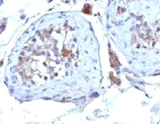 SHBG Antibody - Formalin-fixed, paraffin-embedded human testicular carcinoma stained with SHBG antibody (SHBG/245).  This image was taken for the unmodified form of this product. Other forms have not been tested.