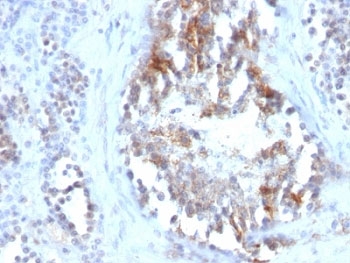 SHBG Antibody - Formalin-fixed, paraffin-embedded human testicular carcinoma stained with SHBG antibody (SPM605).  This image was taken for the unmodified form of this product. Other forms have not been tested.