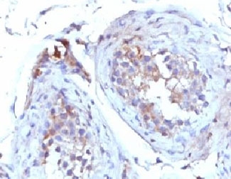 SHBG Antibody - IHC testing of FFPE human testicular carcinoma with SHBG antibody (clone TTEB3).  This image was taken for the unmodified form of this product. Other forms have not been tested.