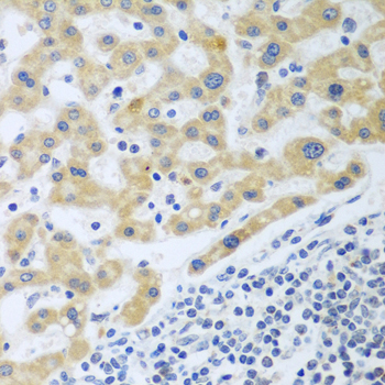 SHBG Antibody - Immunohistochemistry of paraffin-embedded human liver cancer tissue.