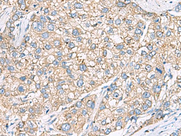 SHC3 / SHCC Antibody - Immunohistochemistry of paraffin-embedded Human liver cancer tissue  using SHC3 Polyclonal Antibody at dilution of 1:40(×200)