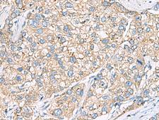 SHC3 / SHCC Antibody - Immunohistochemistry of paraffin-embedded Human liver cancer tissue  using SHC3 Polyclonal Antibody at dilution of 1:40(×200)