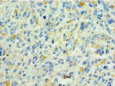 SHC4 Antibody - Immunohistochemistry of paraffin-embedded human melanoma using antibody at 1:100 dilution.