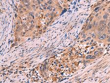 SHC4 Antibody - Immunohistochemistry of paraffin-embedded Human cervical cancer tissue  using SHC4 Polyclonal Antibody at dilution of 1:85(×200)