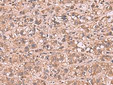 SHC4 Antibody - Immunohistochemistry of paraffin-embedded Human liver cancer tissue  using SHC4 Polyclonal Antibody at dilution of 1:90(×200)