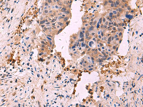 SHC4 Antibody - Immunohistochemistry of paraffin-embedded Human cervical cancer tissue  using SHC4 Polyclonal Antibody at dilution of 1:90(×200)