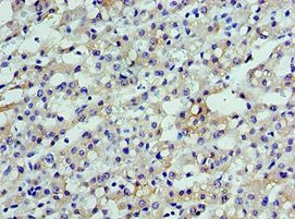 SHFM3 / FBXW4 Antibody - Immunohistochemistry of paraffin-embedded human liver cancer using antibody at 1:100 dilution.