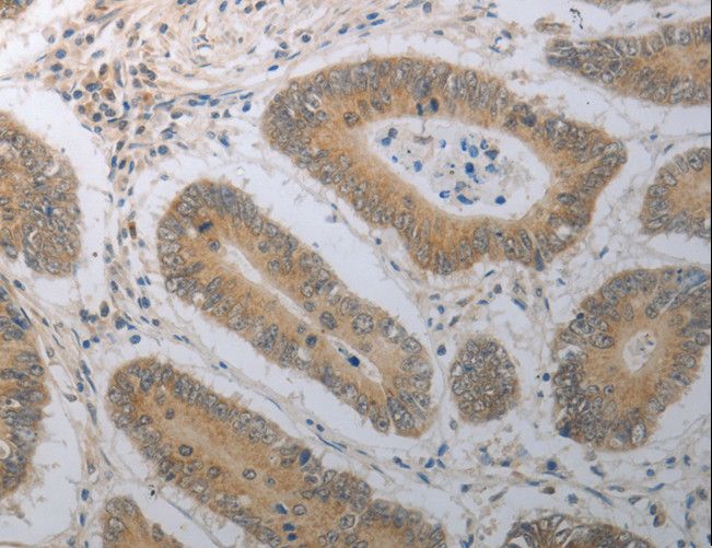 SHH / Sonic Hedgehog Antibody - Immunohistochemistry of paraffin-embedded Human colon cancer using SHH Polyclonal Antibody at dilution of 1:70.