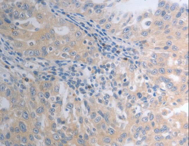 SHH / Sonic Hedgehog Antibody - Immunohistochemistry of paraffin-embedded Human ovarian cancer using SHH Polyclonal Antibody at dilution of 1:40.