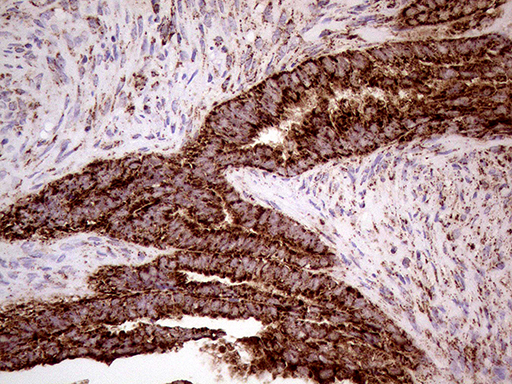 SHMT / SHMT2 Antibody - Immunohistochemical staining of paraffin-embedded Adenocarcinoma of Human endometrium tissue using anti-SHMT2 mouse monoclonal antibody. (Heat-induced epitope retrieval by 1mM EDTA in 10mM Tris buffer. (pH8.5) at 120°C for 3 min. (1:500)