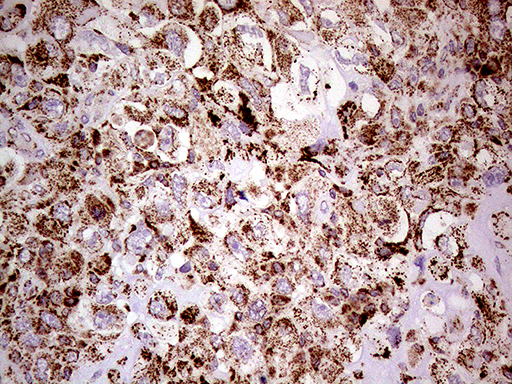 SHMT / SHMT2 Antibody - Immunohistochemical staining of paraffin-embedded Adenocarcinoma of Human breast tissue tissue using anti-SHMT2 mouse monoclonal antibody. (Heat-induced epitope retrieval by 1mM EDTA in 10mM Tris buffer. (pH8.5) at 120°C for 3 min. (1:500)