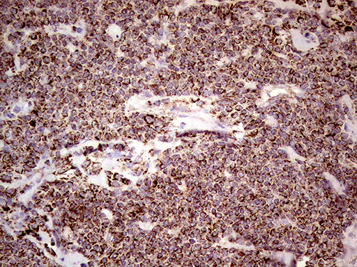 SHMT / SHMT2 Antibody - Immunohistochemical staining of paraffin-embedded Human lymphoma tissue using anti-SHMT2 mouse monoclonal antibody. (Heat-induced epitope retrieval by 1mM EDTA in 10mM Tris buffer. (pH8.5) at 120°C for 3 min. (1:500)